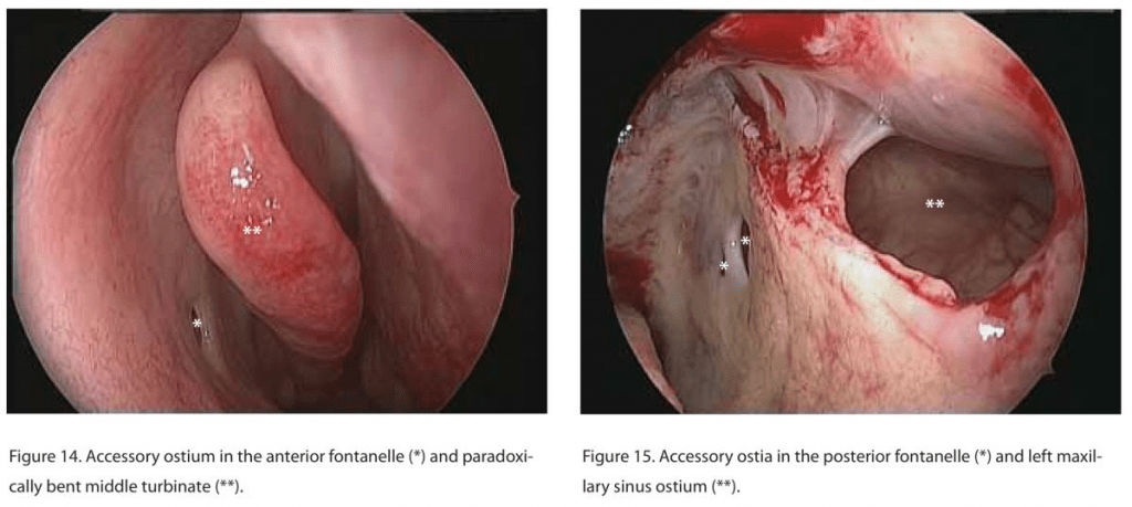 Anatomy of Lateral wall of Nose 10 Fontanelles