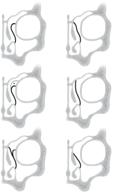 Anatomy of Lateral wall of Nose 9 According to Landsberg and Friedman, there are six variations in the attachment of uncinated process superiorly